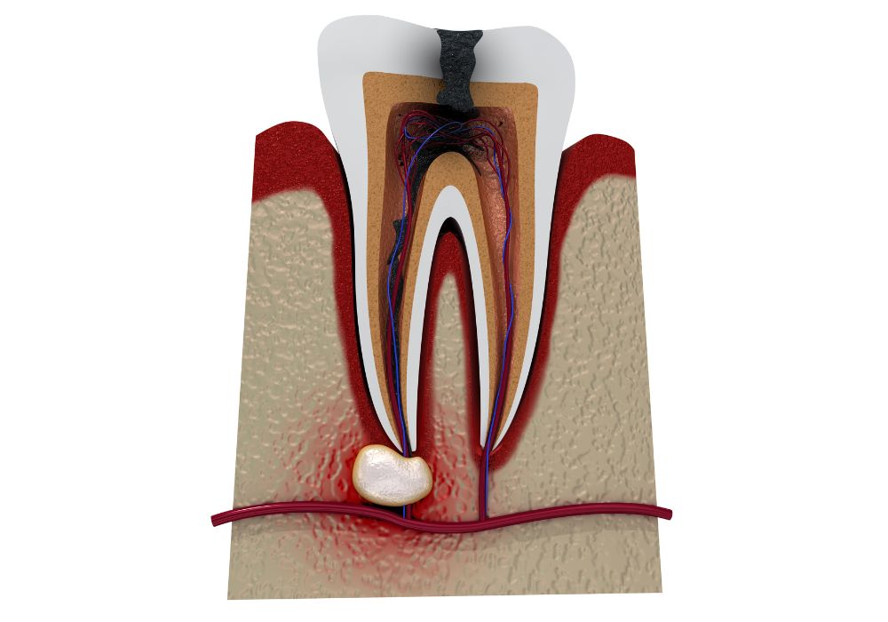 lesion apicale - cabinet dentaire des Drs Wivines, Heymans et Turquet - Esch-sur-Alzette, Luxembourg.